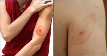 Коварные клещи: опасности, которые вас подстерегают
