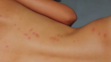 Укусы клопов: признаки, опасность, симптоматика после укуса, как устранить симптомы и вывести клопов