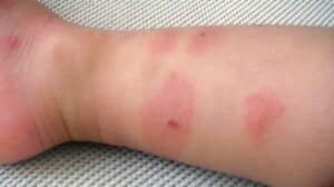 Аллергия на клопов: симптомы, причины и способы лечения