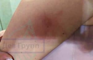 Куда кусают клопы: основные места укусов и как справиться с ними